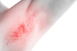 Myth 1: Is laser hair removal painful?