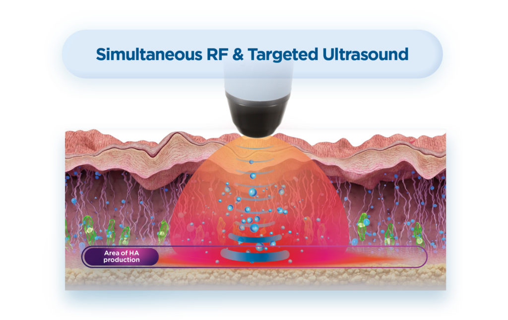 Radiofrequency Paris