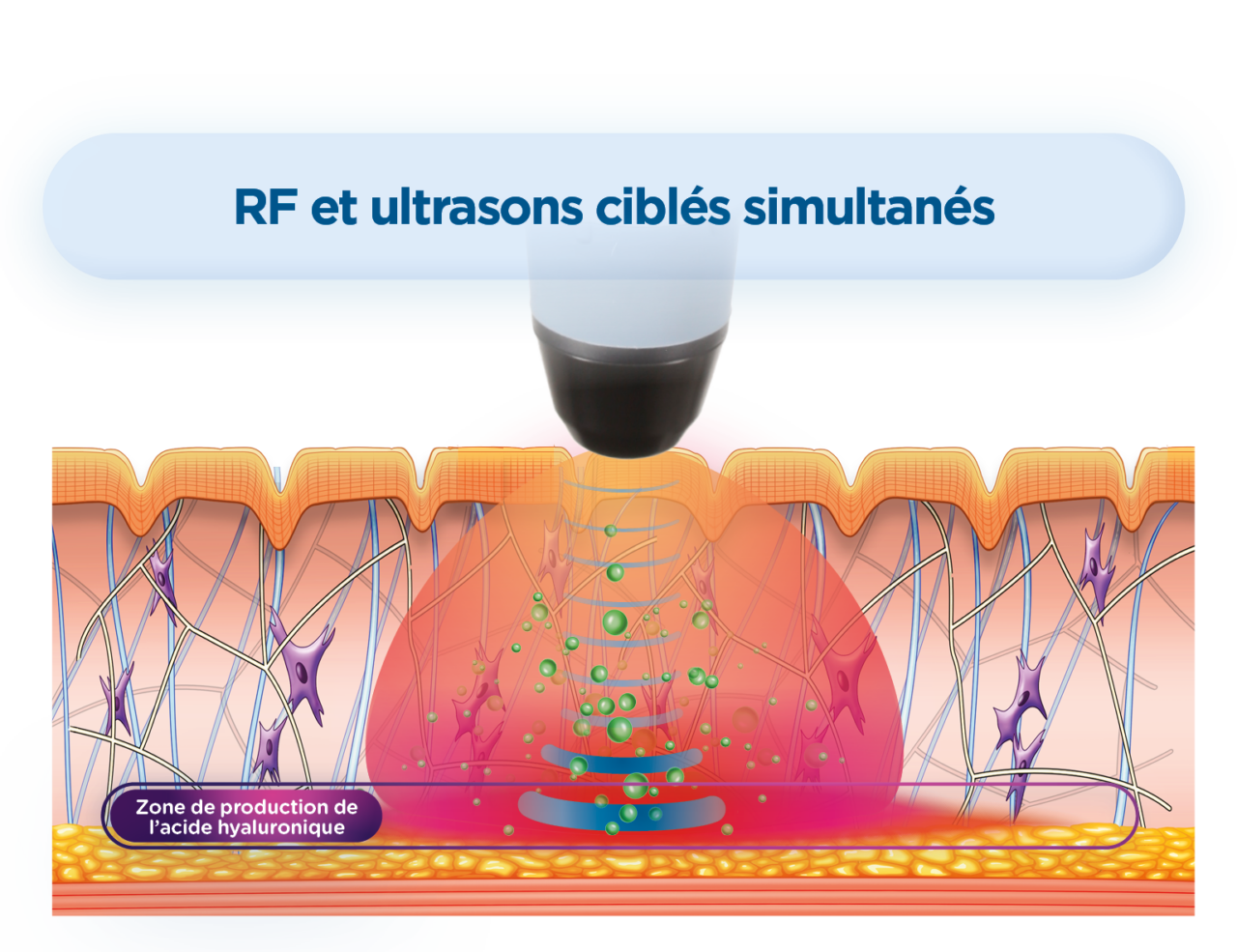 radiofréquence EXION