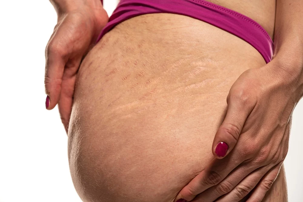 cellulite et vergetures sur les fessiers